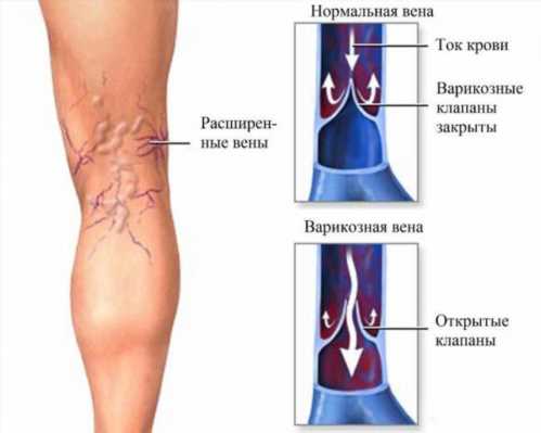 діабетична ангіопатія