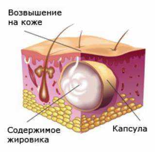 Жировик на спині